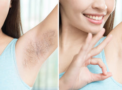 Laser Hair Removal Vs. Electrolysis: Which One Is Better For Your Skin?