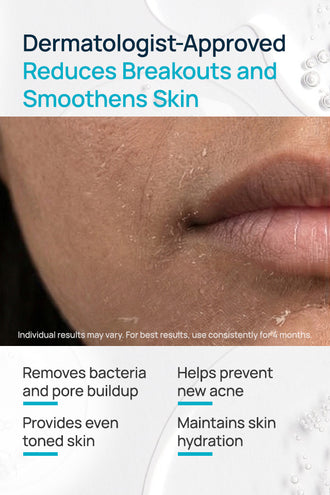 Acne-Limit Facial Toner With 0.1% Cucumber Extract & 0.1% Tea Tree Extract