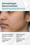 Acne-Limit Facial Toner With 0.1% Cucumber Extract & 0.1% Tea Tree Extract