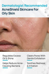 AcneShield Oily Skin Regimen With Cleanser & Moisturizer