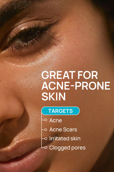 Acne Control Combo For Combination Skin