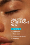 Acne Control Combo For Dry Skin