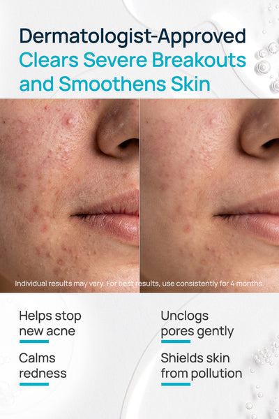 Acne Exfoliating Facial Cream For Women