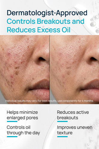 Acne-Limit Facial Cream With 9% Azelaic Acid & 4% Niacinamide