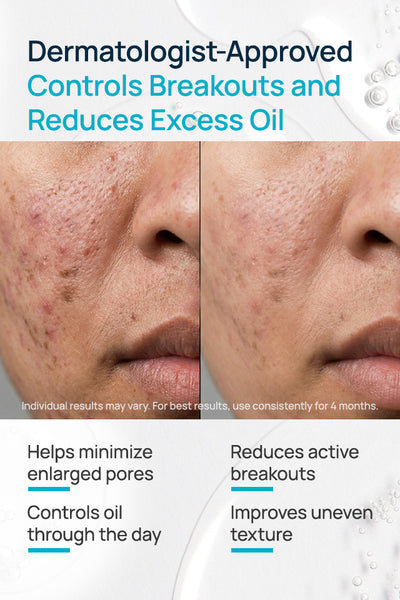 Acne-Limit Facial Cream