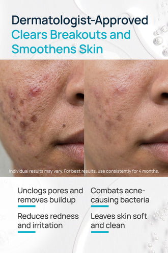 Salicylic Acid And Niacinamide Anti-Acne Face Mask With 1% Salicylic Acid & 2% Niacinamide