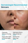 Syndet Regimen With Cleanser & Moisturizer