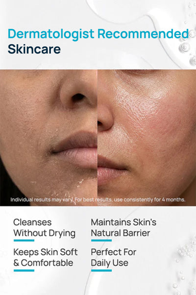 Syndet Regimen With Cleanser & Moisturizer
